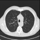 Pneumocystis carinii, pneumocystic pneumonia, follow-up, resolution, HRCT: CT - Computed tomography